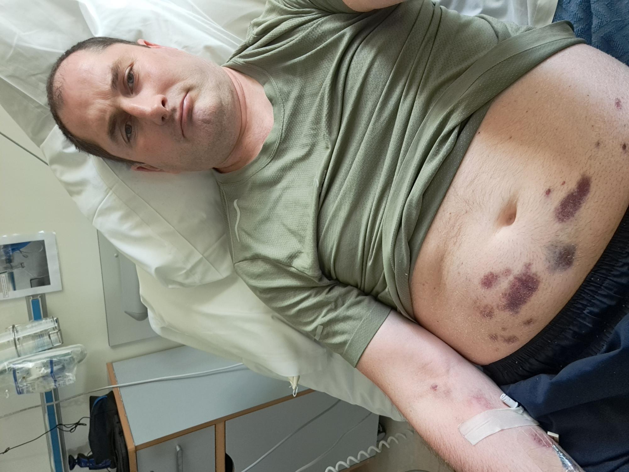 Colin Hawkins during his treatment with bruises